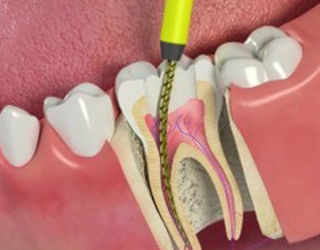 Root Canals 